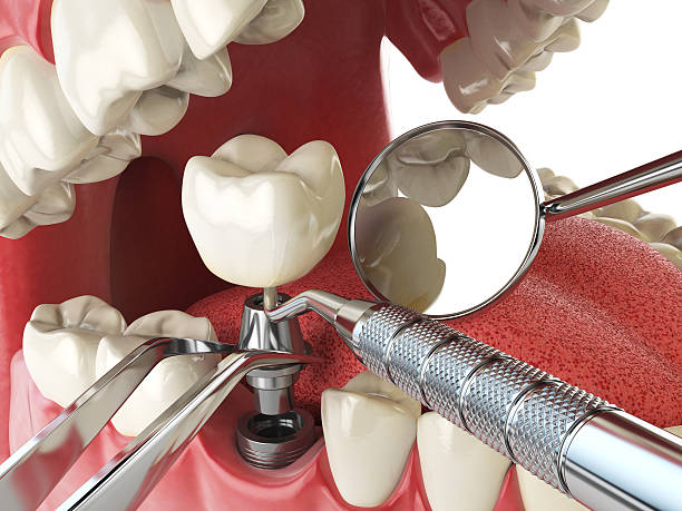 Best Urgent Tooth Repair  in Imperial Beach, CA